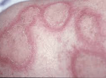 Húðlúpus (e. cutaneous lupus erythematosus) er sjálfsofnæmissjúkdómur sem hefur helst áhrif á húðina, en getur líka verið ein birtingarmynd rauðra úlfa (e. systemic lupus erythematosus) sem er fjölkerfa gigtarsjúkdómur.